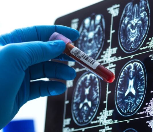 Нові аналізи крові дають надію на ранню діагностику хвороби Альцгеймера